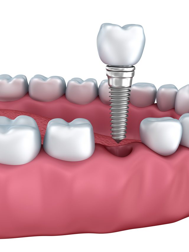 Dental implants: A lifelong solution for missing teeth
